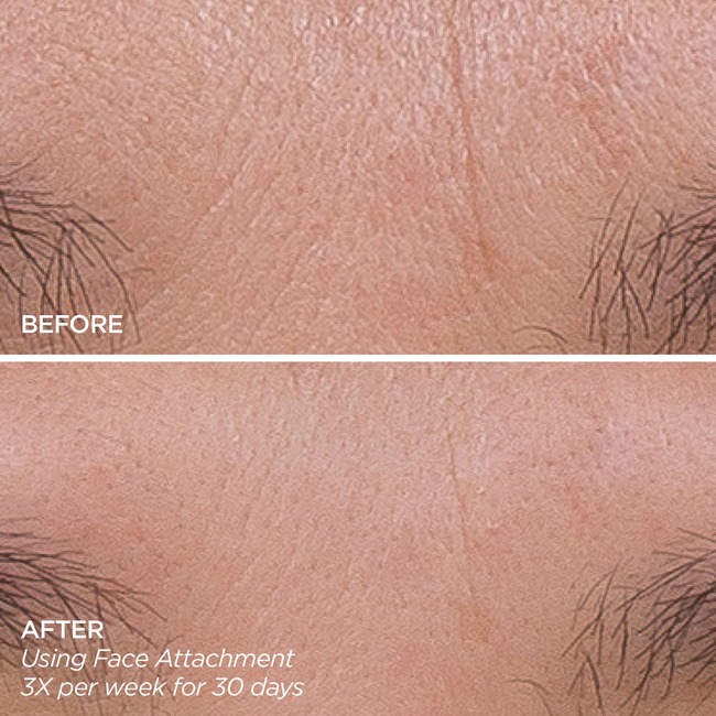 GloPRO® Facial Microneedling Tool-gallery-32706250375361