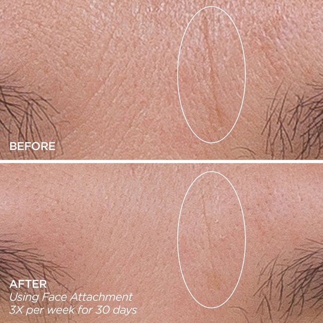 GloPRO® Pink Stripe Set-gallery-47166164336833