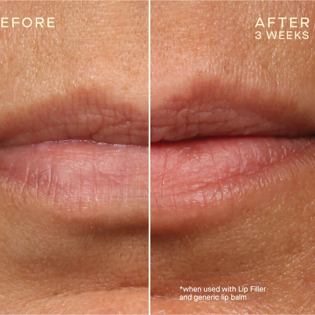 Ourself_BA-Lip-Filler-03_bfad5c37-5c0a-4dff-80ea-32d44ffbc389_876x776_crop_center.webp