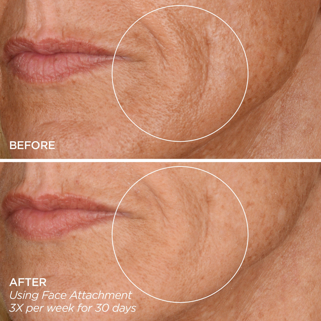 GloPRO® Pink Stripe Set-gallery-47012692820161