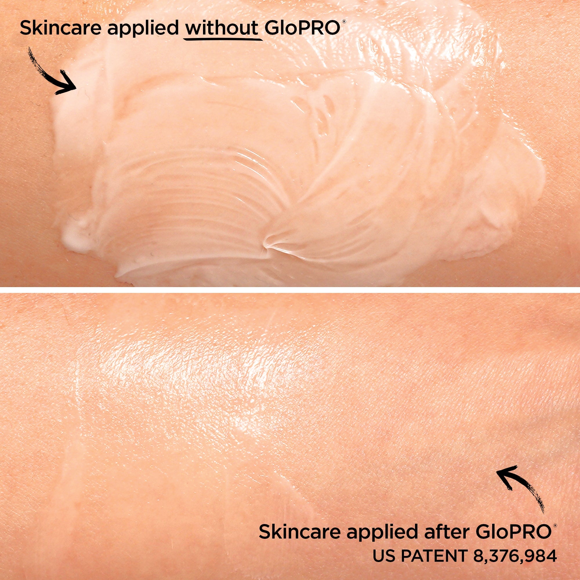 GloPRO® Facial Microneedling Tool